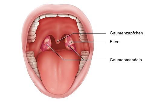 Mandelentzündung: Wie lange bleiben die Symptome bestehen?