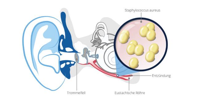 Diagnose und Vorbeugung von Mittelohrentzündungen: Wie wird die Erkrankung festgestellt und wie kann man ihr vorbeugen? Diagnose und Vorbeugung von Mittelohrentzündungen: Wie wird die Erkrankung festgestellt und wie kann man ihr vorbeugen?