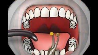 Dauer der Wundheilung nach einer Zahnentfernung: Was Sie wissen sollten Dauer der Wundheilung nach einer Zahnentfernung: Was Sie wissen sollten