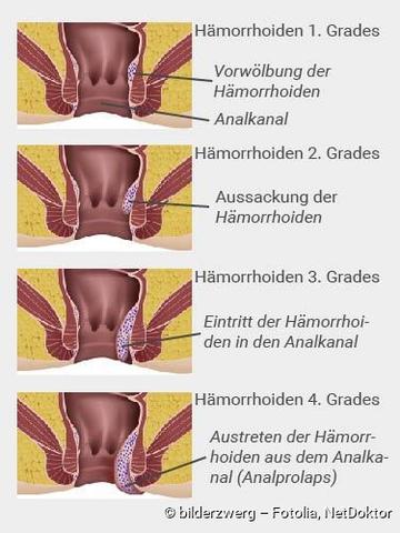 Zeitlicher Verlauf der Hämorrhoidenschwellung und Heilung Zeitlicher Verlauf der Hämorrhoidenschwellung und Heilung