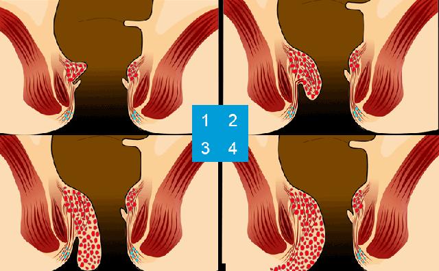 Wie lange brauchen Hämorrhoiden, um abzuschwellen? Wie lange brauchen Hämorrhoiden, um abzuschwellen?
