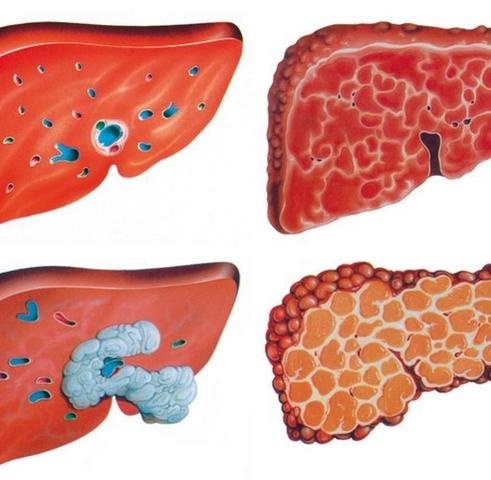 Wie viel Zeit benötigt die Rückbildung einer Fettleber? Wie viel Zeit benötigt die Rückbildung einer Fettleber?