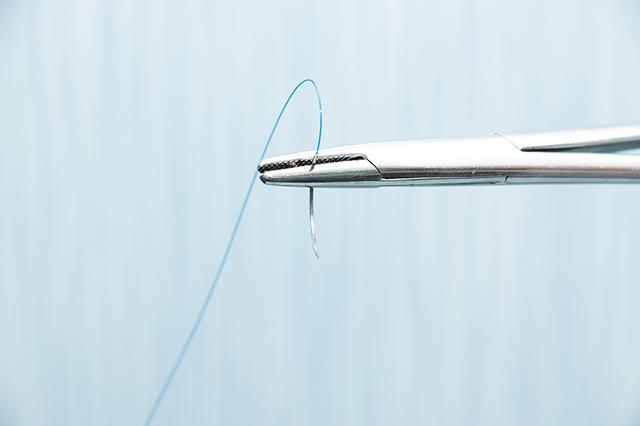 Wie lange dauert es, bis sich selbstauflösende Fäden auflösen? Erfahren Sie mehr.