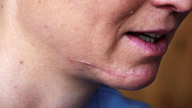 Wie lange braucht eine genähte Wunde zum Heilen? Wie lange braucht eine genähte Wunde zum Heilen?