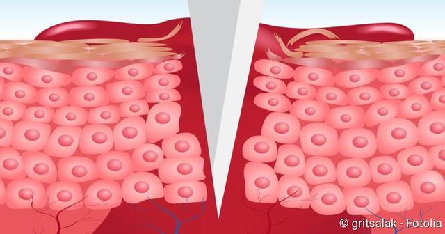 Genähte Wunden: Wie lange dauert die Heilung? Genähte Wunden: Wie lange dauert die Heilung?