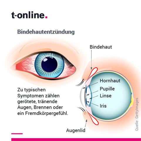 Ansteckungsgefahr bei Bindehautentzündung: Wie lange besteht sie? Ansteckungsgefahr bei Bindehautentzündung: Wie lange besteht sie?