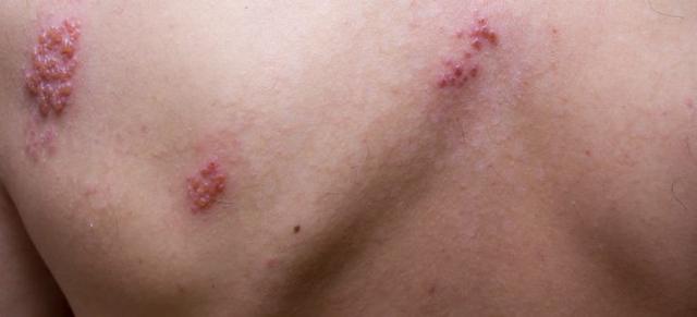 Gürtelrose: Wie lange besteht die Möglichkeit, andere anzustecken?