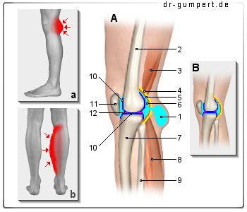 Arbeitsunfähigkeit nach Operation einer Bakerzyste: Wie lange?