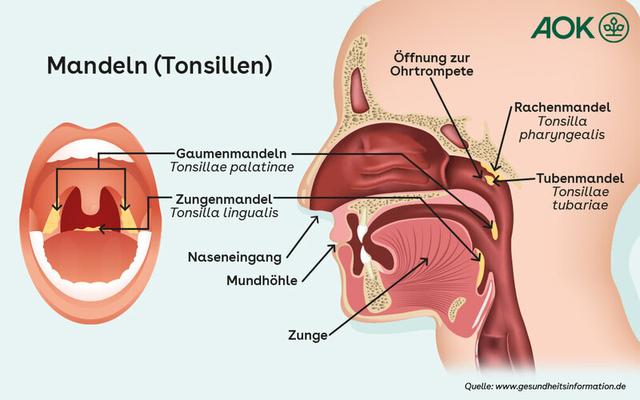 Wie lange ist eine Mandelentzündung ansteckend? Wie lange ist eine Mandelentzündung ansteckend?
