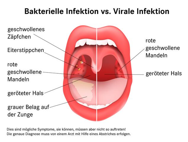 Ansteckungszeitraum bei Tonsillitis - wie lange dauert er? Ansteckungszeitraum bei Tonsillitis - wie lange dauert er?