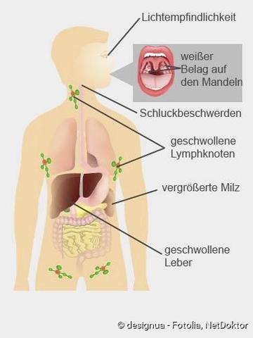 Ansteckungsgefahr bei Pfeifferschem Drüsenfieber: Wie lange bleibt man ansteckend? Ansteckungsgefahr bei Pfeifferschem Drüsenfieber: Wie lange bleibt man ansteckend?