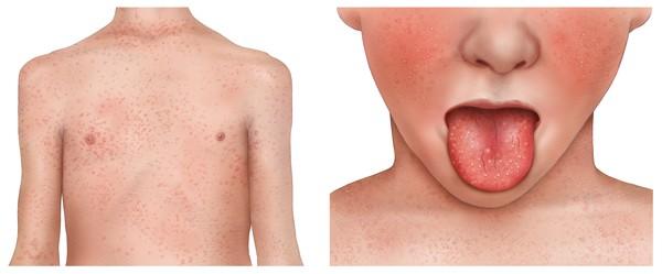 Ansteckungszeitraum von Scharlach: Was Sie beachten sollten Ansteckungszeitraum von Scharlach: Was Sie beachten sollten