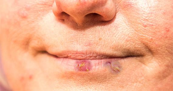 Lippenherpes-Behandlung: Wie lange ist Küssen verboten?