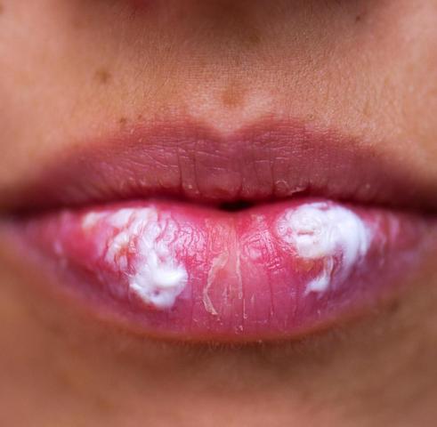 Lippenherpes: Wie lange sollte man auf das Küssen verzichten?