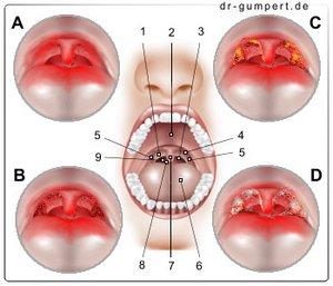 Dauer der Krankschreibung bei Mandelentzündung Dauer der Krankschreibung bei Mandelentzündung