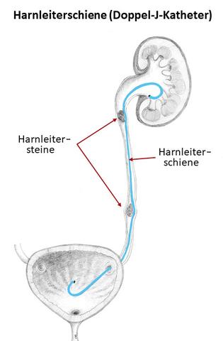 Arbeit und Krankmeldung nach Nierensteinbehandlung: Wie lange? Arbeit und Krankmeldung nach Nierensteinbehandlung: Wie lange?