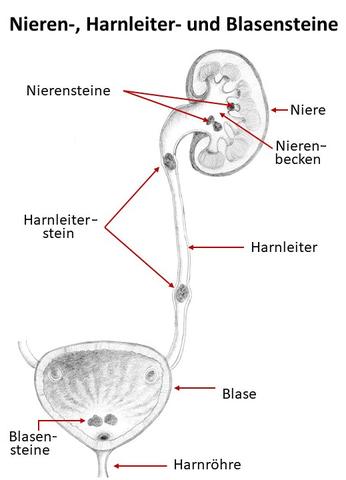 Wie lange dauert die Krankschreibung nach der Zertrümmerung von Nierensteinen? Wie lange dauert die Krankschreibung nach der Zertrümmerung von Nierensteinen?