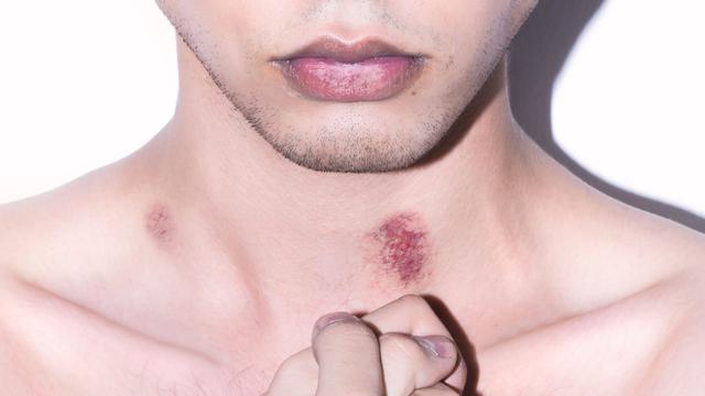 Knutschfleck-Magie: Wie man einen sichtbaren Liebesbeweis hinterlässt Knutschfleck-Magie: Wie man einen sichtbaren Liebesbeweis hinterlässt