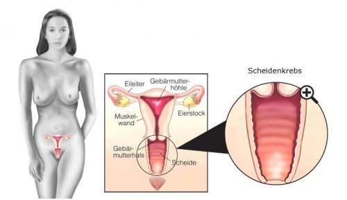 Scheidenkrebs im Bild: Wie sieht der Tumor aus?