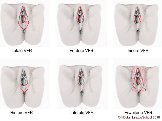 Wie sieht Scheidenkrebs aus? Bilder und Informationen
