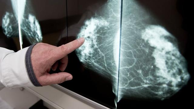 Mammographie-Ergebnisse: Wie erkennt man Brustkrebs auf den Bildern?
