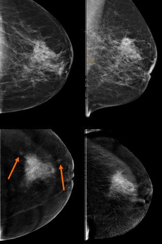 Die Darstellung von Brustkrebs in der Mammographie