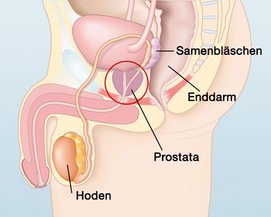 Symptome und Verlauf von Prostatakrebs: Wie stirbt man an Prostatakrebs?