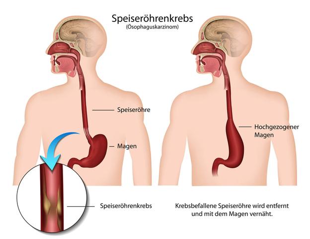 Symptome und Risikofaktoren von Speiseröhrenkrebs: Erkennen und Vorbeugen Symptome und Risikofaktoren von Speiseröhrenkrebs: Erkennen und Vorbeugen