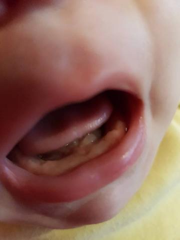 Der Zahndurchbruch bei Babys: Wie sieht das aus? Der Zahndurchbruch bei Babys: Wie sieht das aus?