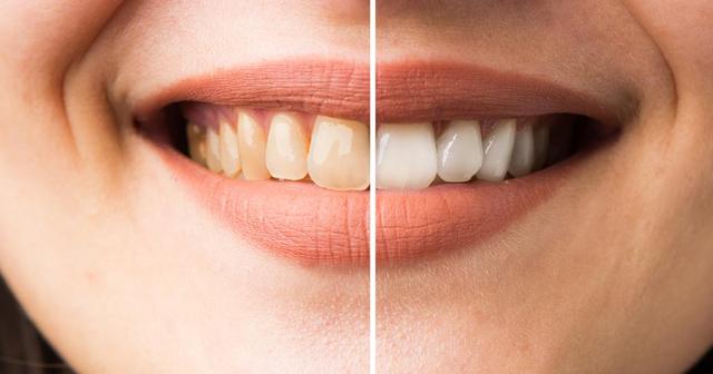 Zähne aufhellen ohne den Zahnarzt: 10 einfache Methoden für zu Hause Zähne aufhellen ohne den Zahnarzt: 10 einfache Methoden für zu Hause