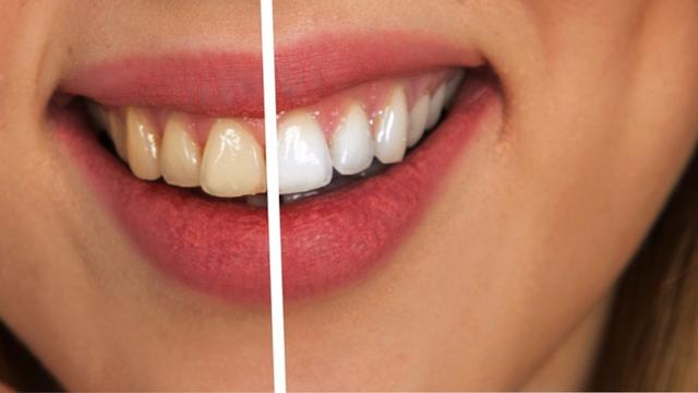 Schöne weiße Zähne dank Hausmittel: 10 praktische Tipps zum Bleaching Schöne weiße Zähne dank Hausmittel: 10 praktische Tipps zum Bleaching