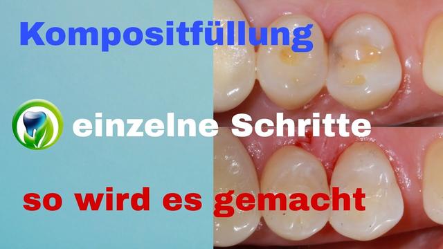 Zahnfüllung selber machen: Schritt-für-Schritt-Anleitung Zahnfüllung selber machen: Schritt-für-Schritt-Anleitung