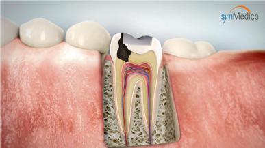 Selbstgemachte Zahnfüllung: Das solltest du beachten Selbstgemachte Zahnfüllung: Das solltest du beachten