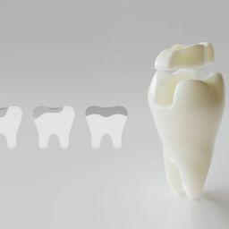 CASA DENTALIS: Professionelle Zahnfüllungen statt Selbstversuch CASA DENTALIS: Professionelle Zahnfüllungen statt Selbstversuch