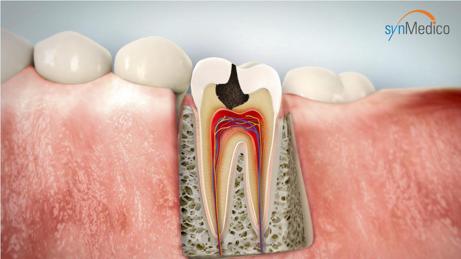 Warum sofort zum Zahnarzt, trotz Möglichkeit der selbstgemachten Zahnfüllung? Warum sofort zum Zahnarzt, trotz Möglichkeit der selbstgemachten Zahnfüllung?