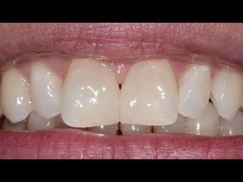 Zahnlücke selber schließen: Tipps und Tricks Zahnlücke selber schließen: Tipps und Tricks