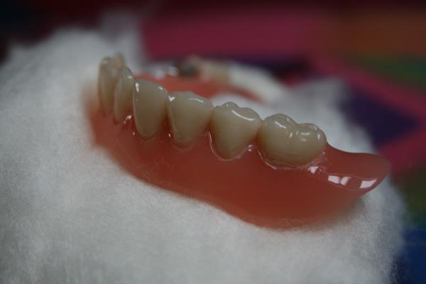 Zahnersatz unterfüttern lassen: Behandlungsablauf und Dauer Zahnersatz unterfüttern lassen: Behandlungsablauf und Dauer