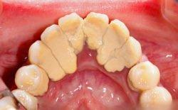Zahnstein bekämpfen: Hausmittel und Methoden zur Selbstbehandlung
