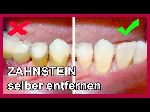 Zahnstein selbst entfernen: Tipps und Hausmittel