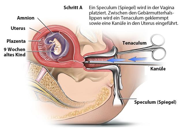 Schwangerschaftsabbruch: Wie lange ist ein Abbruch möglich? Schwangerschaftsabbruch: Wie lange ist ein Abbruch möglich?