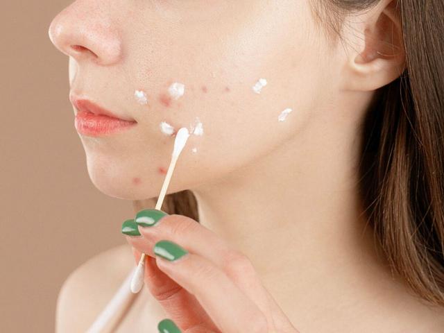 Zinksalbe: Tipps zur richtigen Anwendung und Wirkung auf die Haut Zinksalbe: Tipps zur richtigen Anwendung und Wirkung auf die Haut