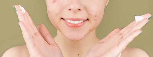 Zinksalbe: Das Wundermittel für Hautprobleme Zinksalbe: Das Wundermittel für Hautprobleme