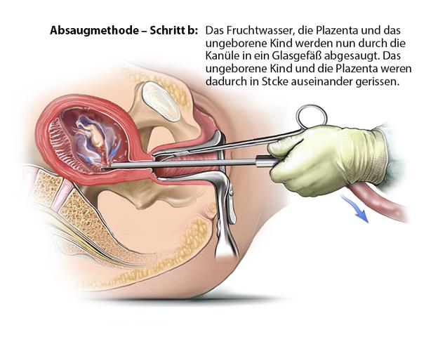 Ab welchem Zeitpunkt gilt eine Schwangerschaft als nicht mehr abtreibbar?