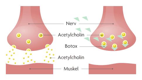 Wie lange dauert es, bis Botox wirkt? Wie lange dauert es, bis Botox wirkt?