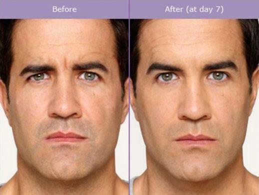 Wie lange dauert es, bis Botox wirkt? - Zeitspanne bis zum maximalen Effekt Wie lange dauert es, bis Botox wirkt? - Zeitspanne bis zum maximalen Effekt