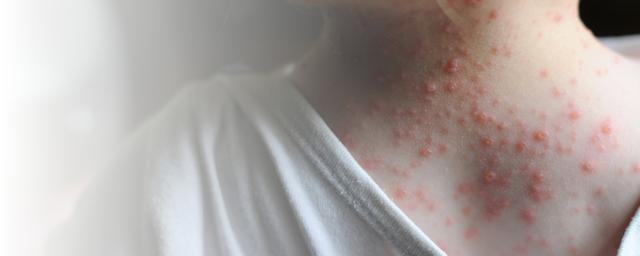 Das Aussehen von Affenpocken: Was Sie über die Hautveränderungen wissen sollten Das Aussehen von Affenpocken: Was Sie über die Hautveränderungen wissen sollten