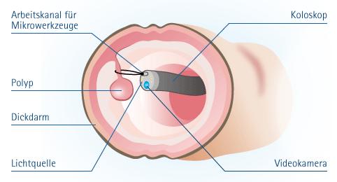 Entdeckte Polypen bei der Koloskopie: Was passiert danach? Entdeckte Polypen bei der Koloskopie: Was passiert danach?