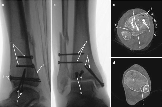Einfluss struktureller Faktoren auf die Prozess- und Ergebnisqualität bei der Frakturbehandlung Einfluss struktureller Faktoren auf die Prozess- und Ergebnisqualität bei der Frakturbehandlung