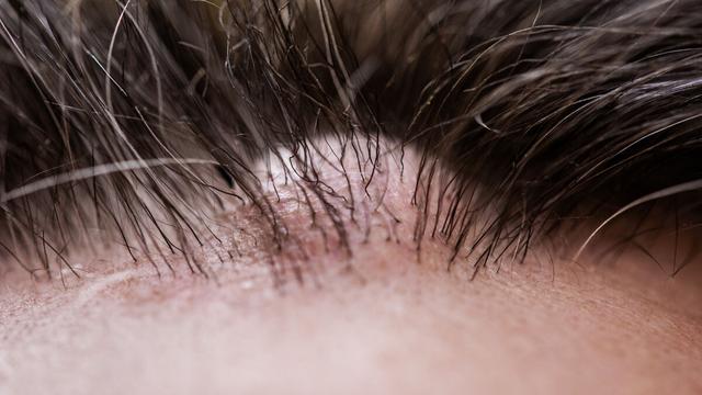 Atherom selbst behandeln: Was Sie wissen sollten