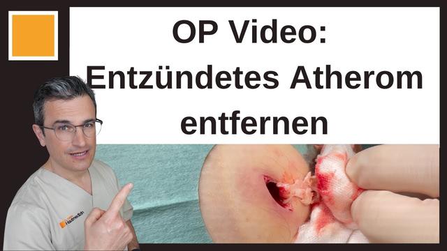 Atherom entfernen ohne Arzt: Vor- und Nachteile